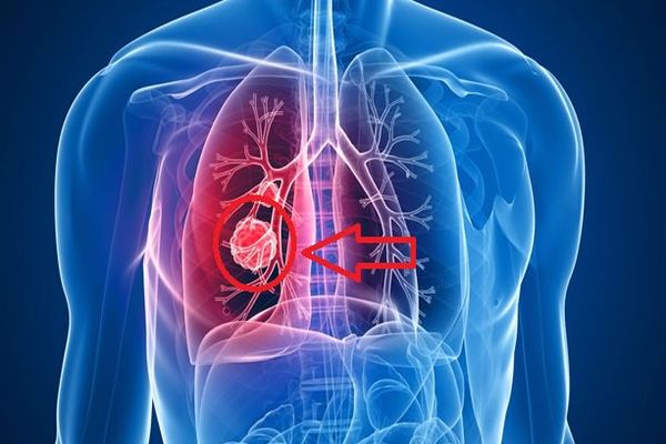 Akciğer kanseri sinsice ilerliyor